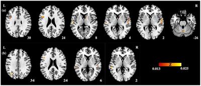 A Meta-Analytic Study of the Neural Systems for Auditory Processing of Lexical Tones